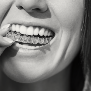 Invisalign Akuta besvär