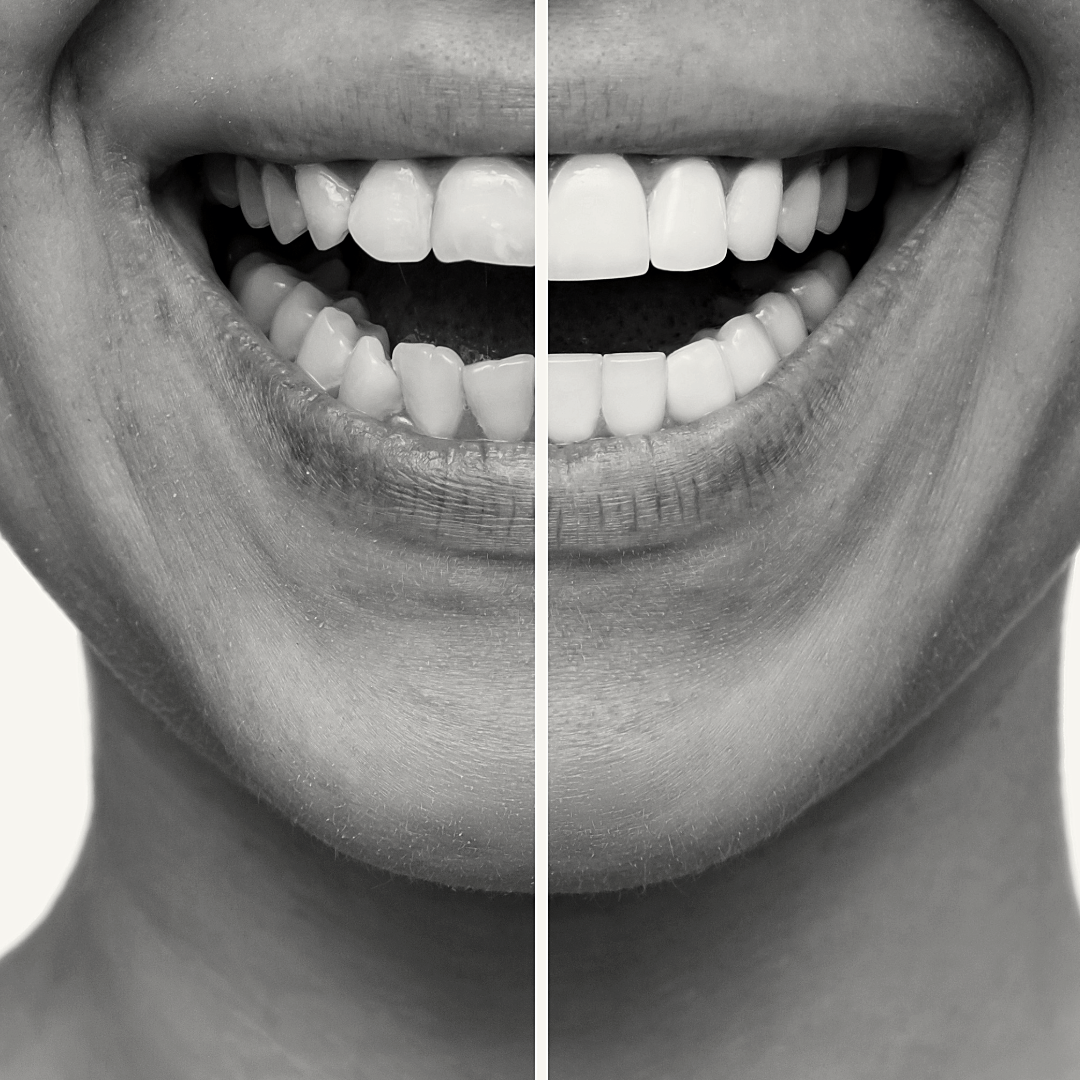 FÖRE & EFTER tandvårdsbehandlingar hos Kungstanden: Upplev enastående förändringar i munhälsa och leende med vår professionella vård.
